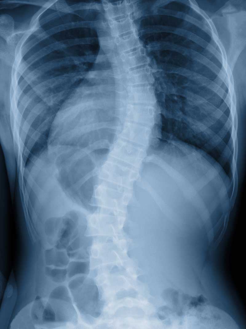 Scoliosis  Highlands Ranch, CO 
